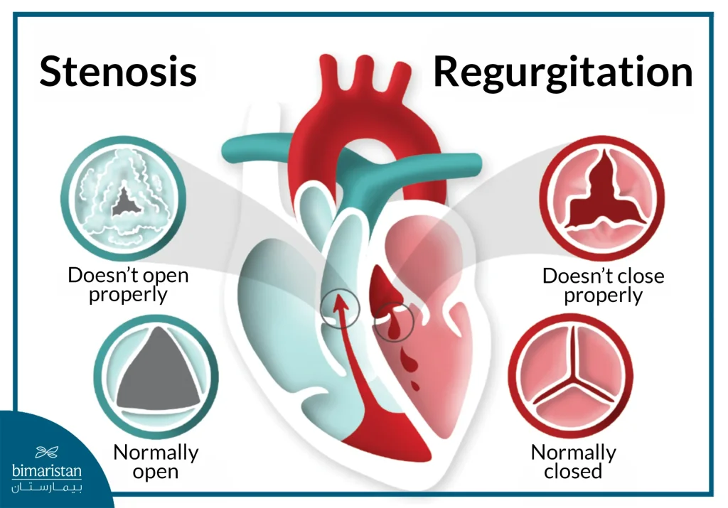Heart Valve Disease: Causes, Signs &Amp; Modern Treatments 3 Image Showing Valve Stenosis And Regurgitation, The Most Common Heart Valve Disease