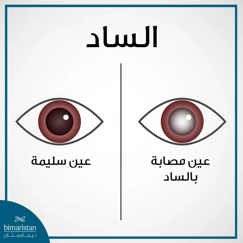 أمراض عدسة العين: فهم المخاطر والخيارات العلاجية 2 الساد (الماء الأبيض) أحد أمراض عدسة العين