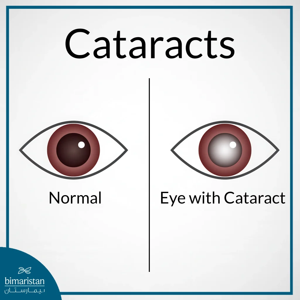 Eye Lens Disorders: Risks And Solutions 2 A Comparison Between A Healthy Eye And One With A Cataract, Showing The Clear And The Cloudy Lens