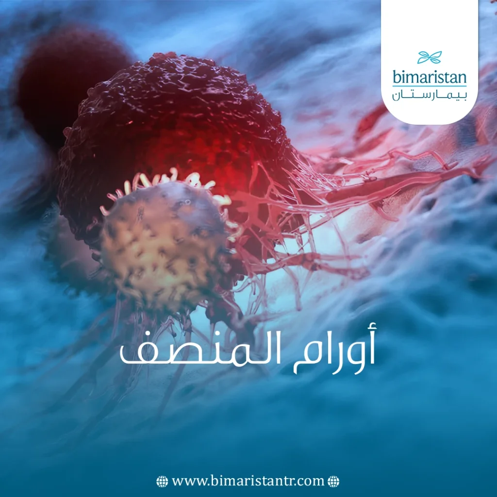 أورام المنصف: الأسباب والأعراض وخيارات العلاج - بيمارستان