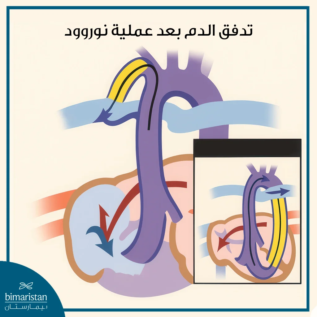 تدفق الدم بعد إجراء نوروود