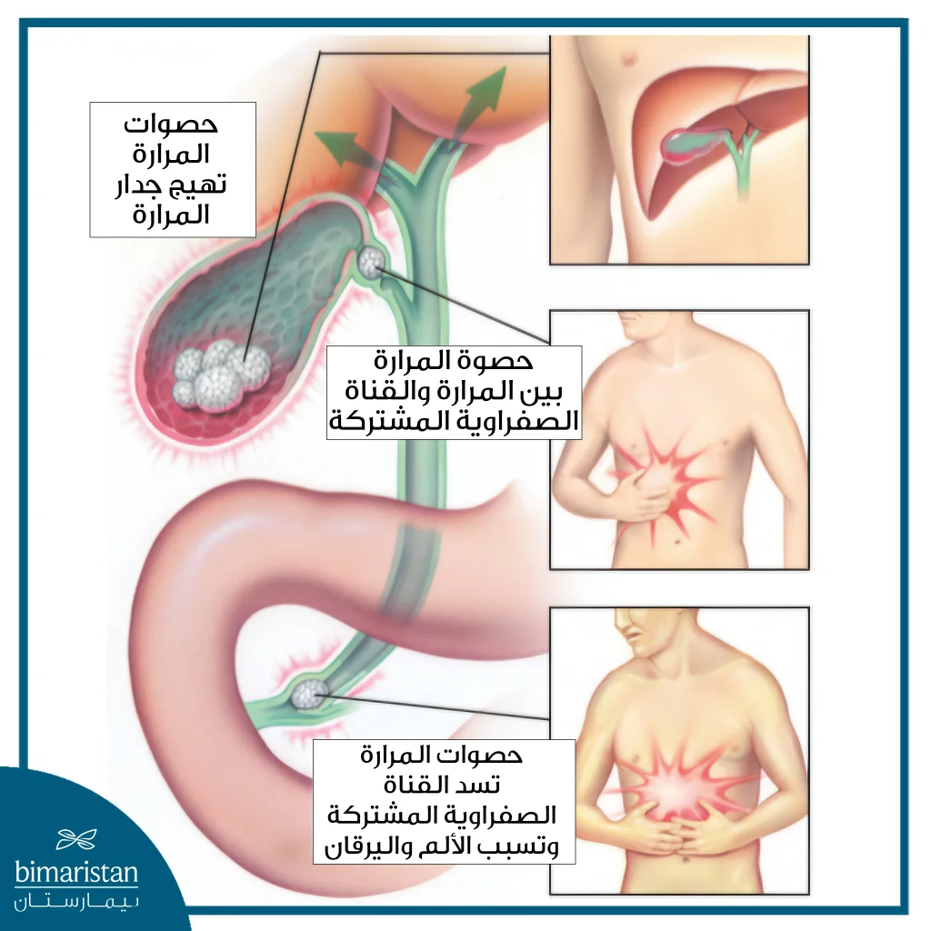 صورة توضح انتقال الحصوات من المرارة إلى القناة الصفراوية