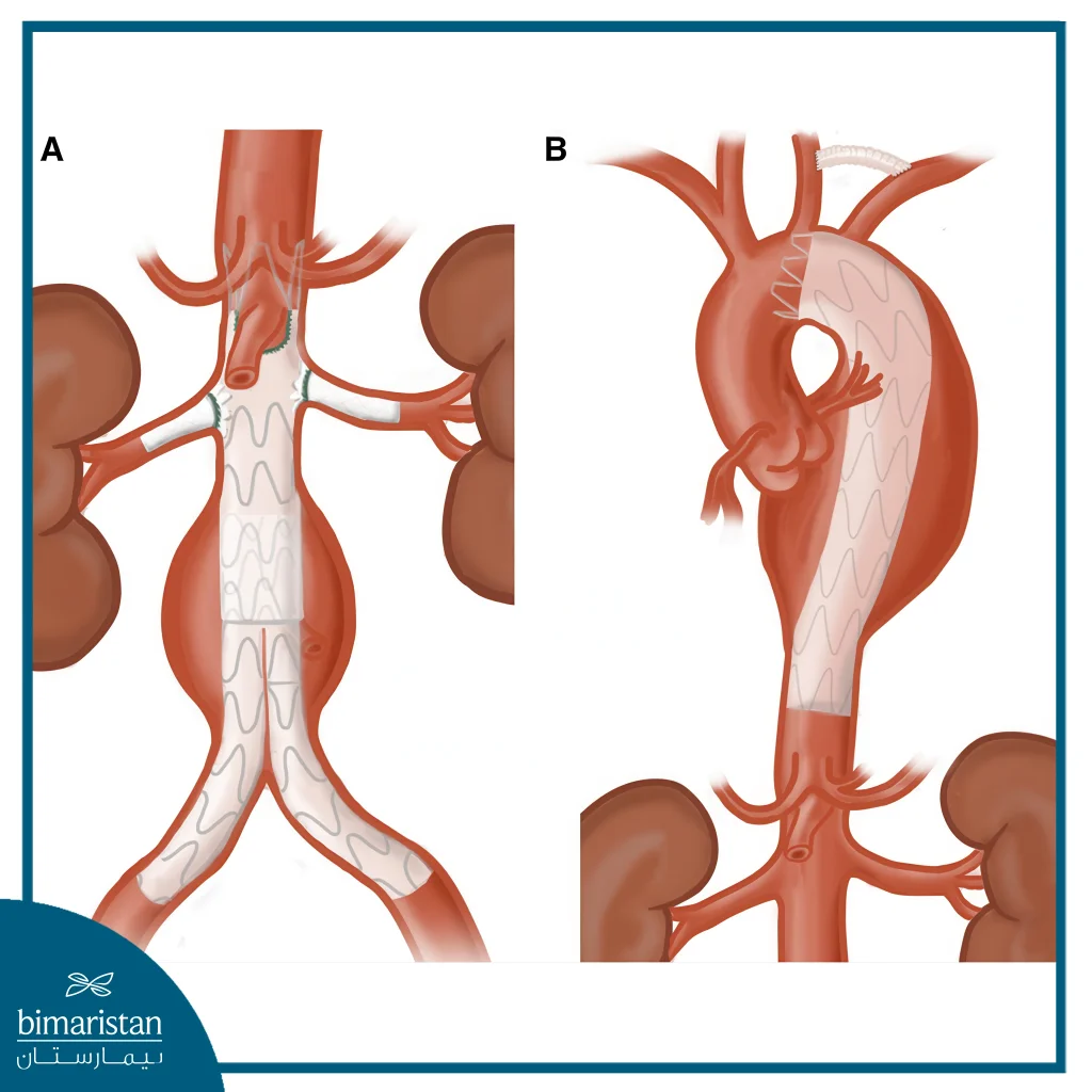 Endovascular Aortic Aneurysm Repair: Effective, Non-Surgical Treatment For Aortic Aneurysms 3 A: Endovascular Aortic Aneurysm Repair Of The Abdominal Aorta With Stent Placement
B: Endovascular Aortic Aneurysm Repair Of The Thoracic Aorta With Stent Placement