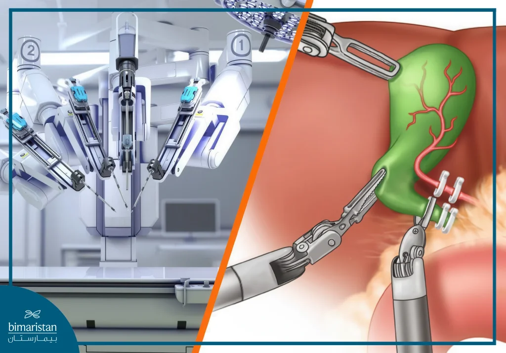 The Da Vinci Surgical System During Cholecystectomy, Showing The Combination Of Robotic Technology And Surgical Precision To Minimize Invasiveness And Improve Outcomes