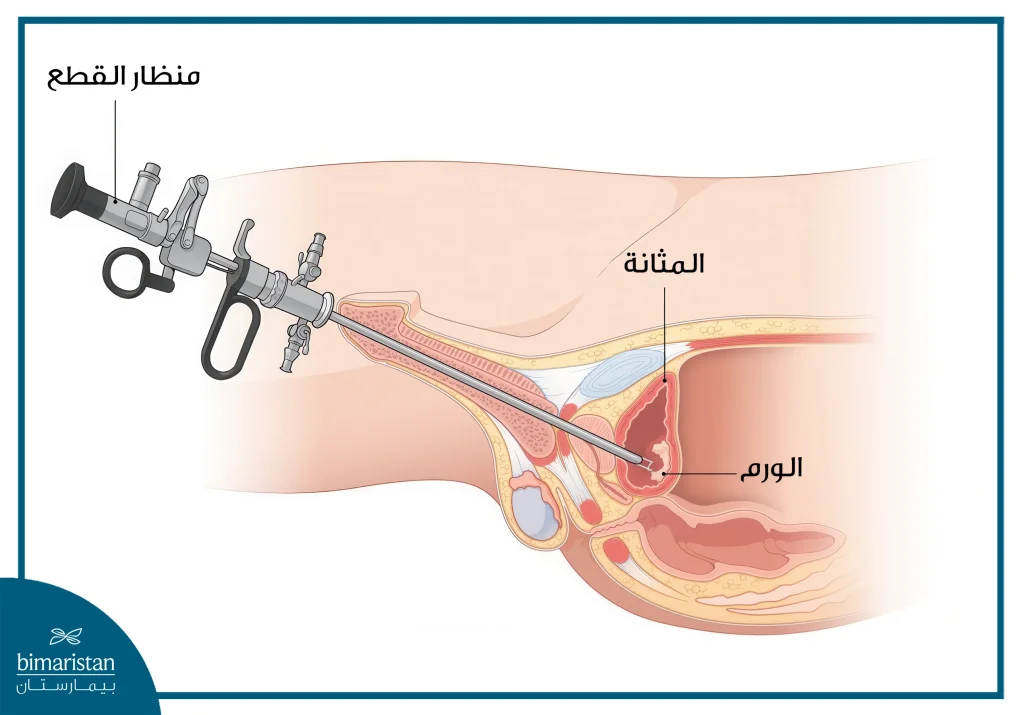 استئصال سرطان المثانة: متى يجرى وما مخاطره؟ 2 صورة توضح عملية استئصال سرطان المثانة والأدوات المستخدمة فيها