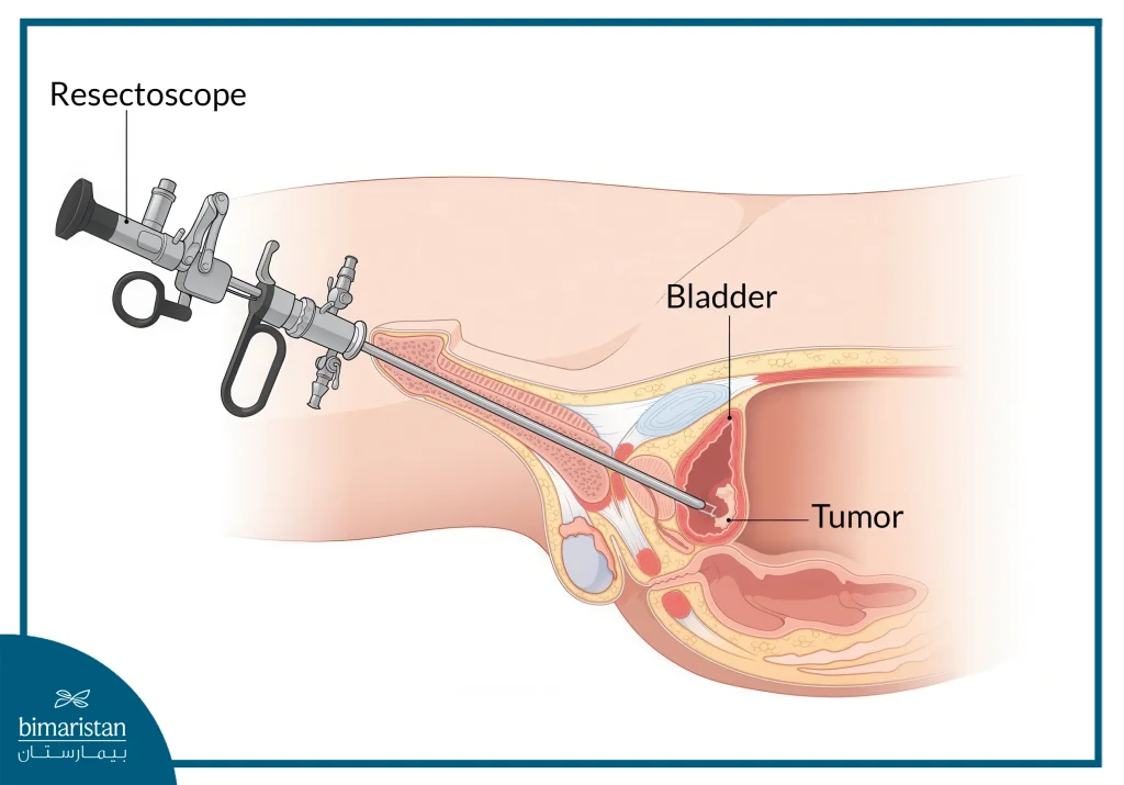 Bladder Cancer Surgery: When It'S Needed And What The Risks Are 2 Image Showing A Bladder Cancer Surgery And The Instruments Used