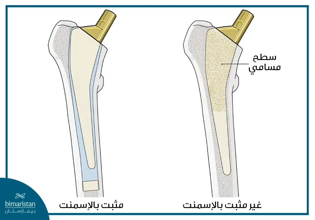 استبدال مفصل الورك الجزئي بتركيا: خبرة عالمية بأسعار مدروسة 7 الفرق بين المفصل المثبت بالإسمنت وغير المثبت