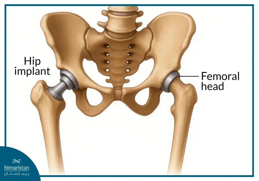 Partial Hip Replacement In Turkey: Expert Care At Affordable Prices 4 Image Showing What An Artificial Joint Looks Like