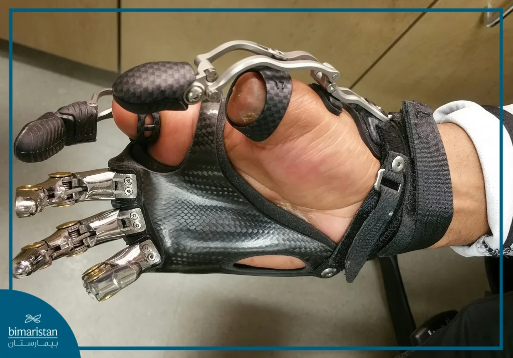 Upper Limb Prosthetics: Restore Mobility And Quality Of Life 6 Image Of A Hybrid Prosthesis