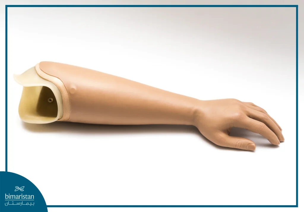 Upper Limb Prosthetics: Restore Mobility And Quality Of Life 2 Image Of A Negative Upper Prosthesis