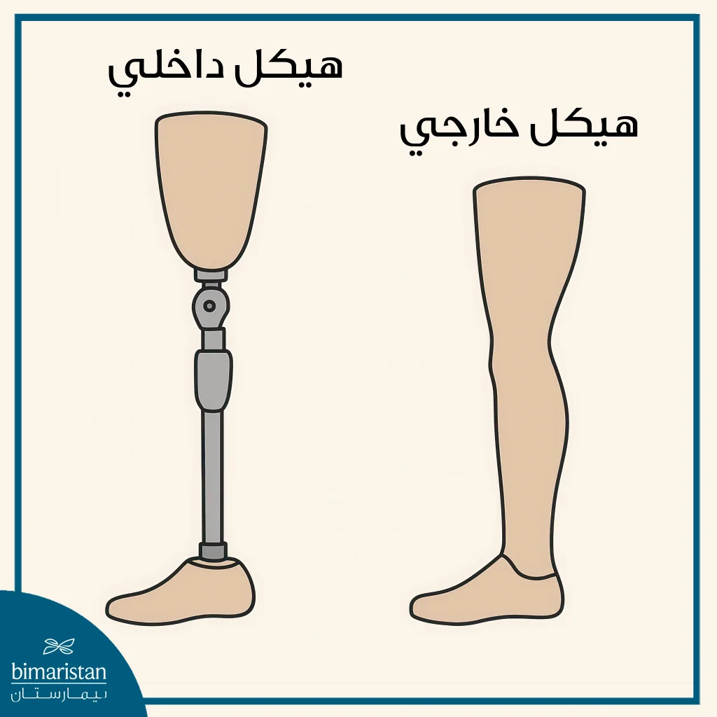 أنواع الأطراف الصناعية فوق الركبة: استعادة الحركة بثقة 3 صورة توضح الفرق بين أنواع الأطراف الصناعية فوق الركبة