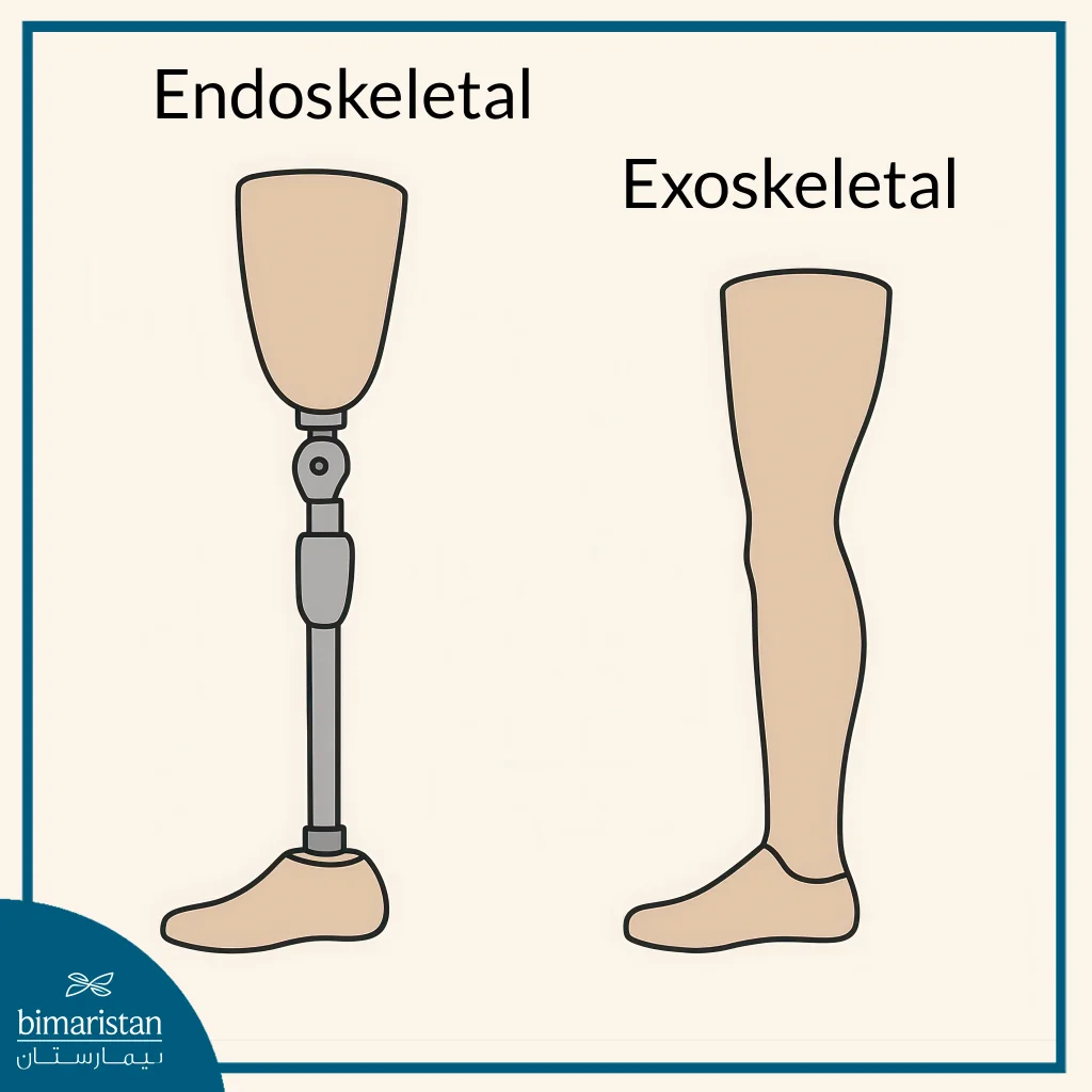 Image Showing The Difference Between Types Of Above-Knee Prosthesis