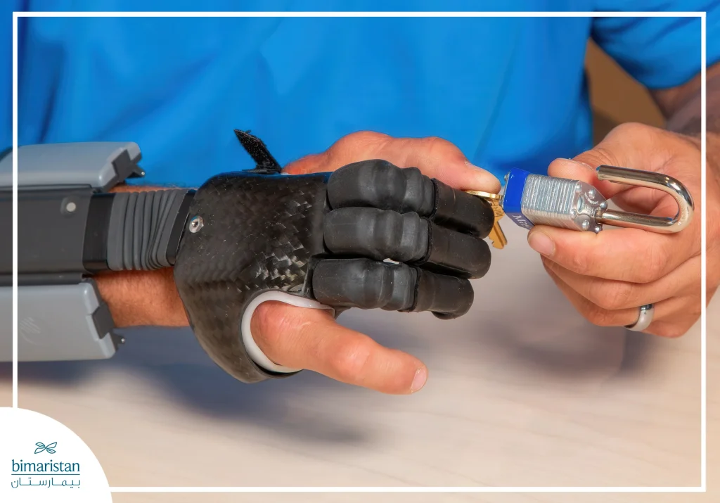 Journey With A Hand Prosthesis Begins With Regaining Mobility And Self-Reliance