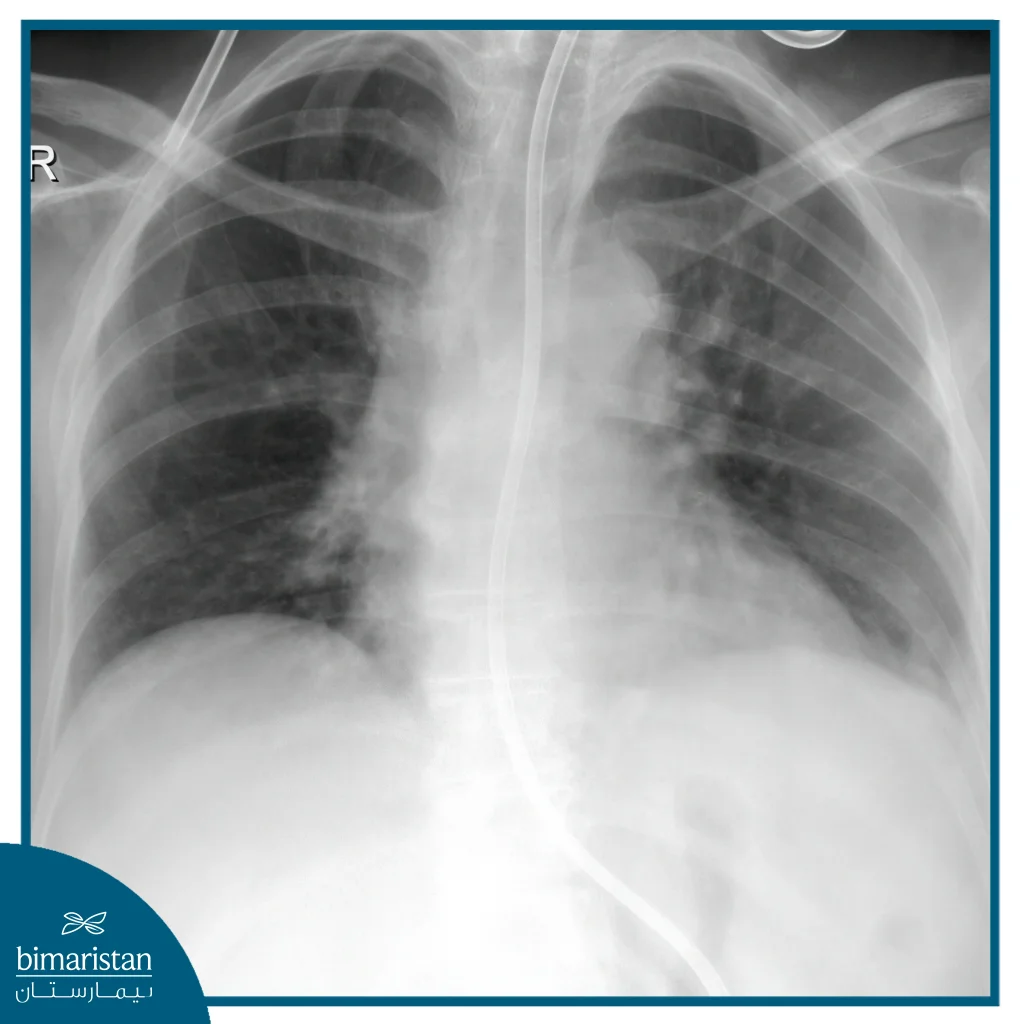 A Chest Radiograph Reveals A Palpable Tumor In The Mediastinum Area, Indicating Inflammation In The Surrounding Tissues Consistent With Mediastinitis.