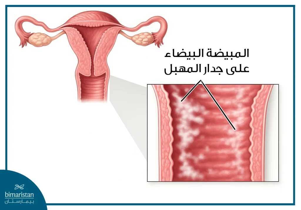 التهاب المهبل الفطري: الأعراض، الأسباب، وطرق العلاج الفعّالة 2 صورة توضح مكان توضع الفطريات التي تسبب التهاب المهبل الفطري