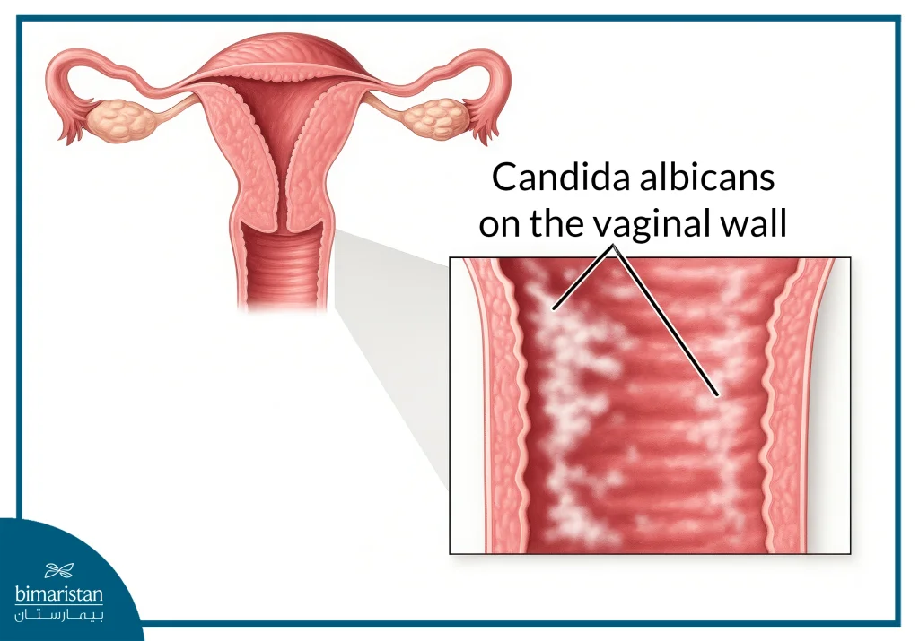 Vaginal Yeast Infection: Symptoms, Causes, Diagnosis, And Best Treatment Options 2 Image Showing The Location Of The Fungus That Causes Vaginal Yeast Infection