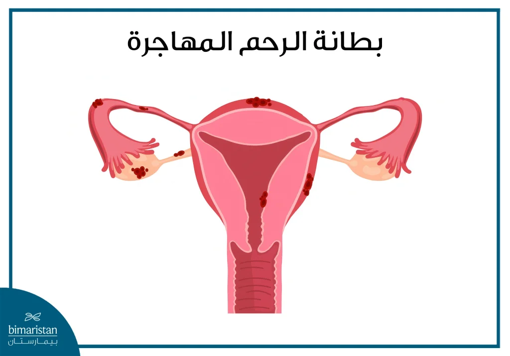 بطانة الرحم المهاجرة أحد الأسباب الشائعة للإصابة بالعقم عند النساء