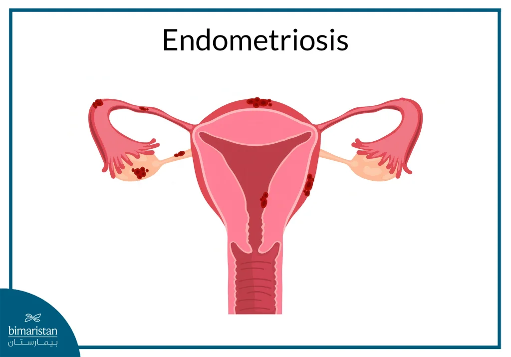 Endometriosis: A Common Cause Of Female Infertility