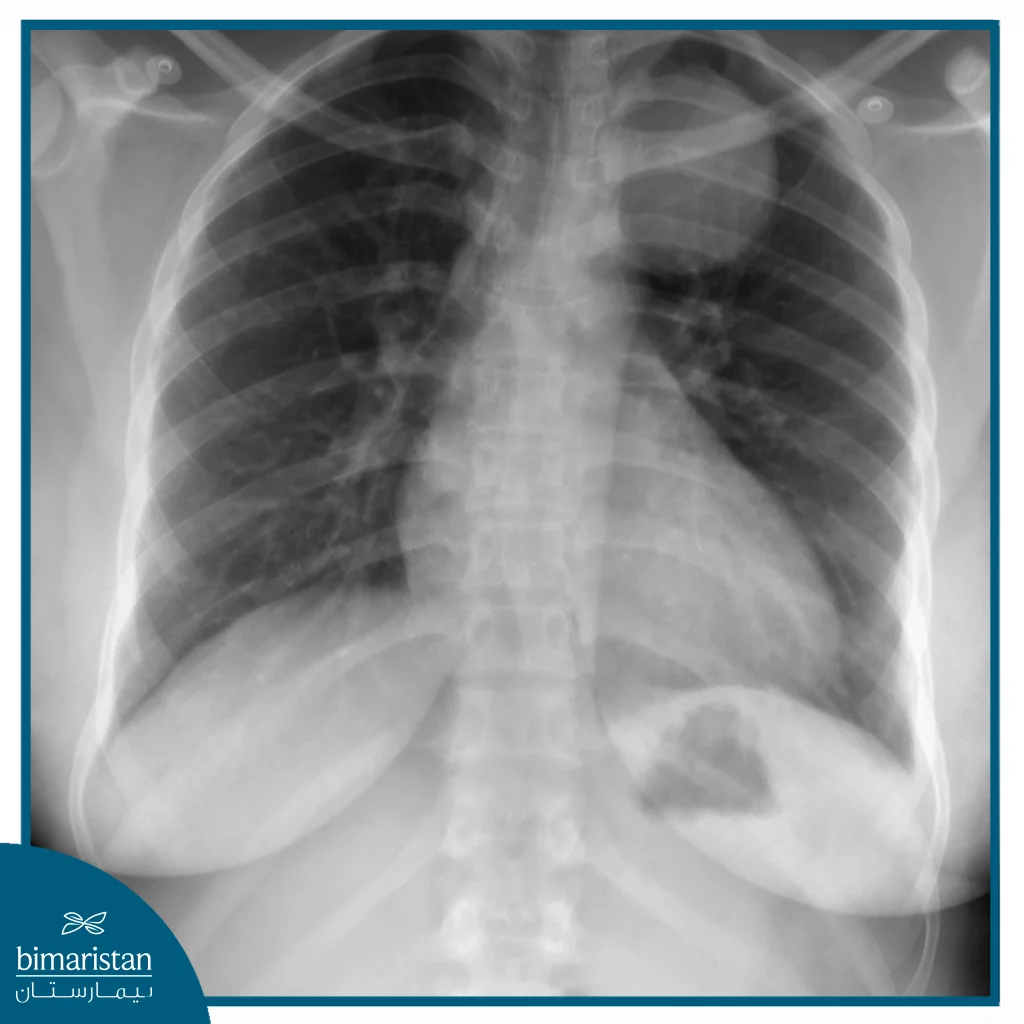 A Chest Radiograph Reveals A Visible Tumor In The Posterior Mediastinum, Highlighting The Importance Of Recognizing The Difference Between Anterior And Posterior Mediastinal Tumors, As It May Indicate Inflammation Or Swelling In The Surrounding Tissues.