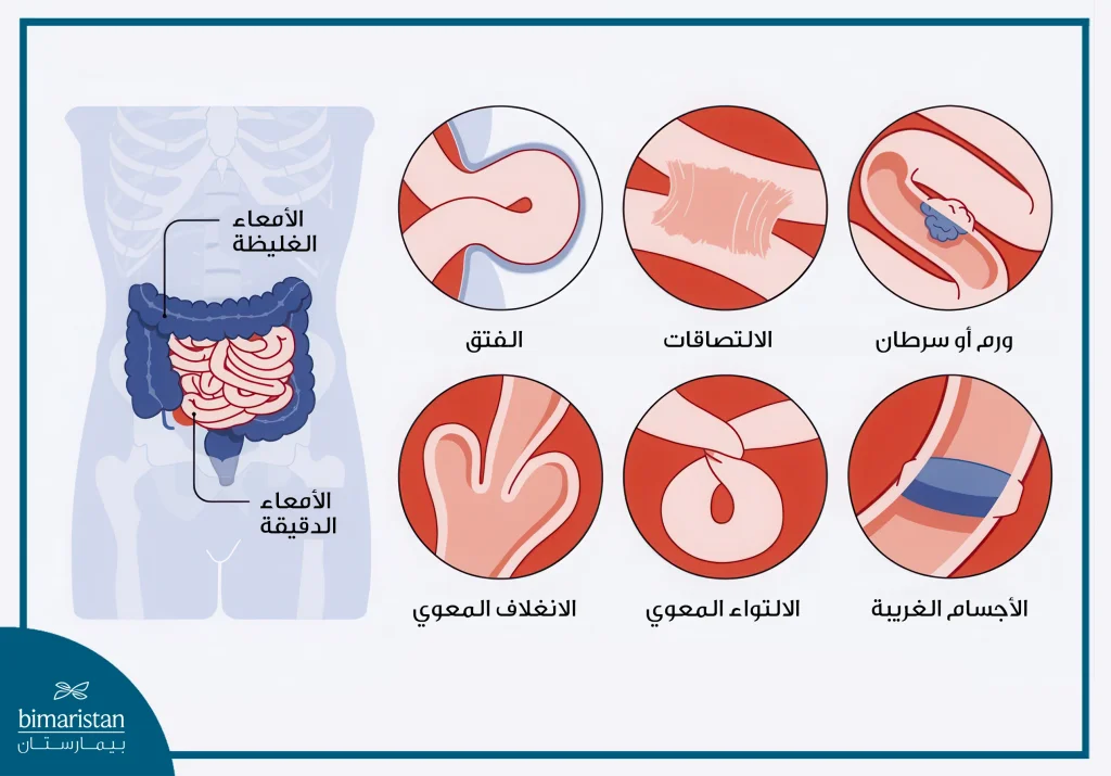 علاج انسداد الأمعاء بالمنظار: خيار فعّال لتفادي الجراحة التقليدية 3 صورة توضح أشكال انسداد الأمعاء