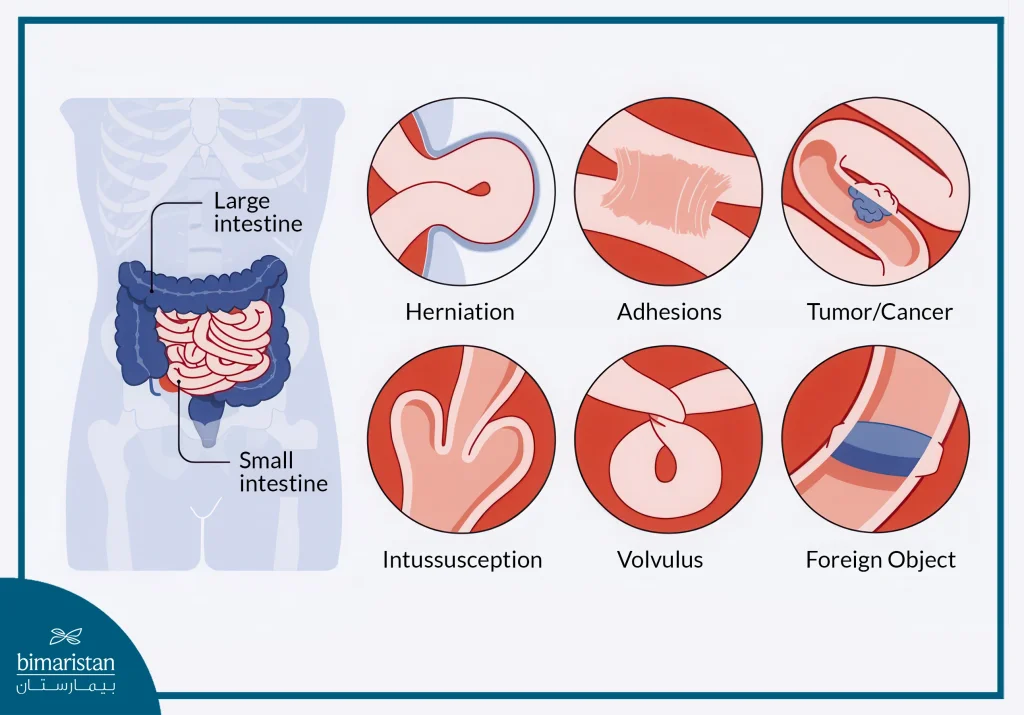 Image Showing Bowel Obstruction And The Steps Of Endoscopic Treatment For Intestinal Obstruction.