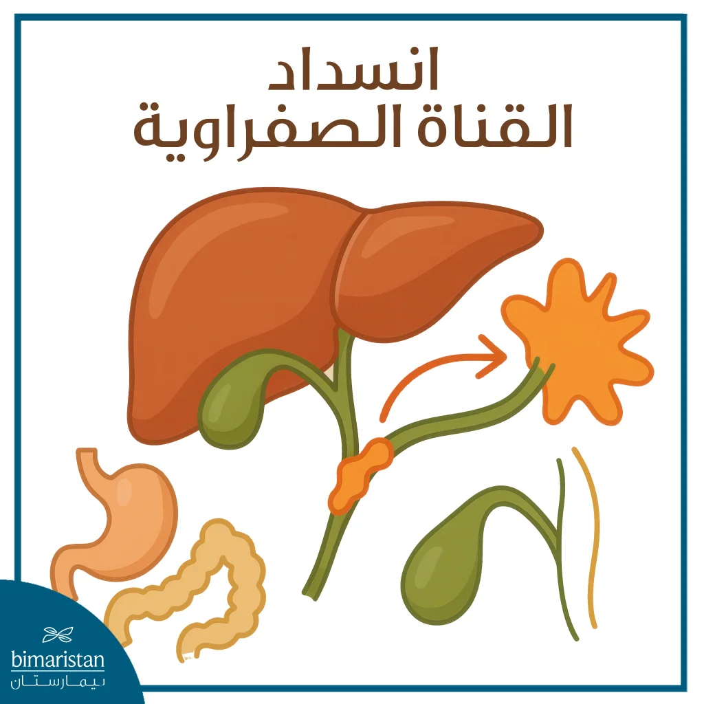 انسداد القناة الصفراوية إحدى استطبابات استئصال المرارة في تركيا 