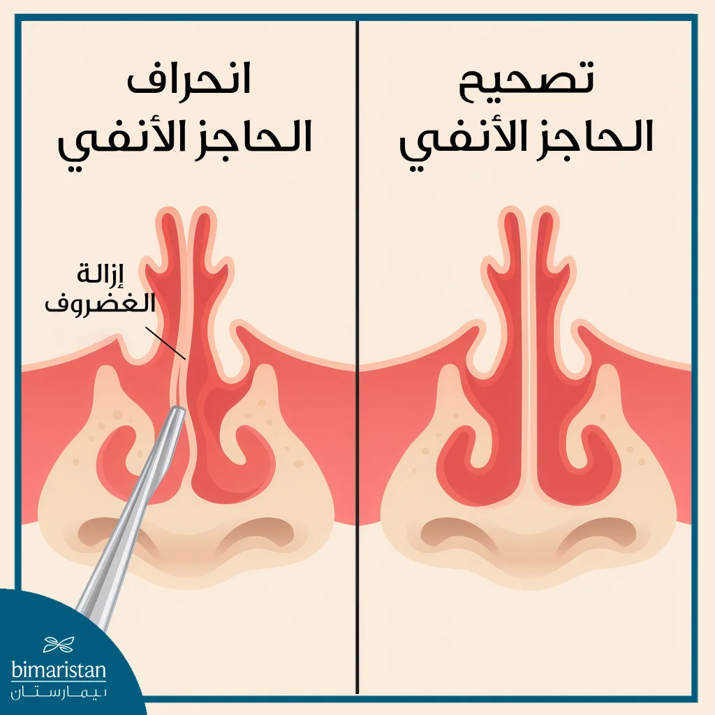 تجميل الأنف: الدليل لأنواع العملية وتكلفتها 2 عملية تجميل الأنف لتصحيح انحراف الحاجز الأنفي