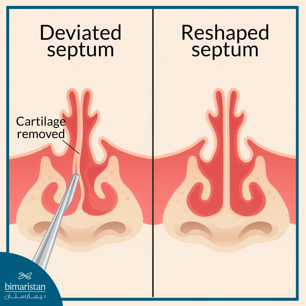 Rhinoplasty: Complete Guide To Types, Benefits, And Costs 2 Rhinoplasty To Correct A Deviated Septum