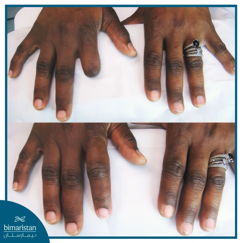 Finger Prosthesis: Realistic, Precise &Amp; Confidence-Boosting 2 Finger Prosthesis Before And After