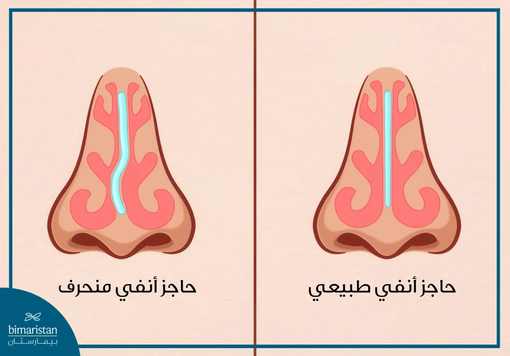 تصحيح أنف الأطفال: متى ولماذا يلجأ الأهل لهذا الإجراء؟ 2 صورة توضح القرق بين الحاجز الأنفي الطبيعي والمنحرف