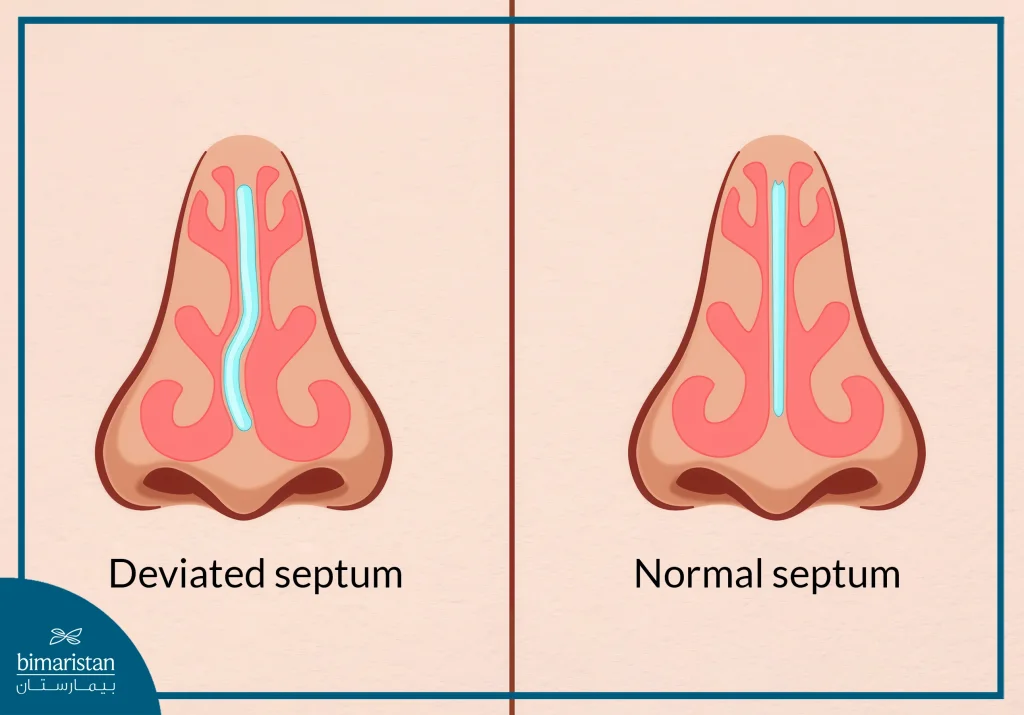 Pediatric Rhinoplasty: When And Why Parents Should Consider This Procedure 2 An Image Illustrating The Difference Between A Normal And Deviated Nasal Septum, With Relevance To Pediatric Rhinoplasty