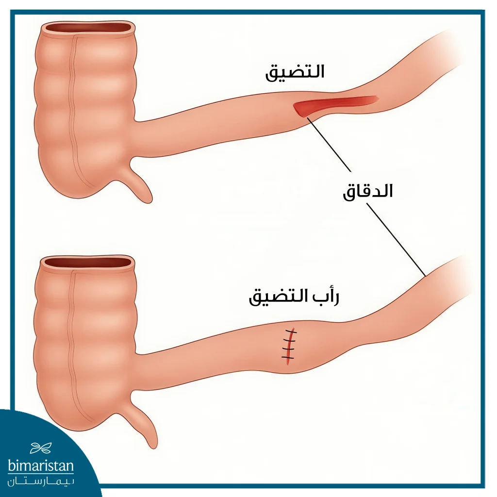تضيق الأمعاء الدقيقة: الأسباب والأعراض وخيارات العلاج 3 شكل يوضح تضيق الأمعاء الدقيقة وكيفية علاجه