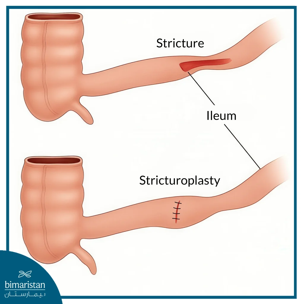 Small Bowel Stricture And How To Treat It