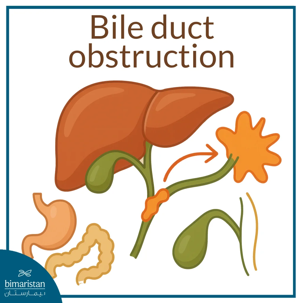 Bile Duct Obstruction Is One Of The Indications For Gallbladder Removal In Turkey