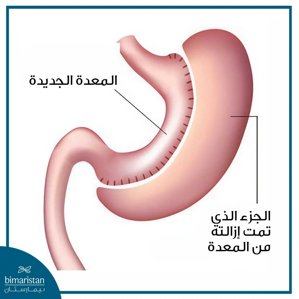 تكلفة استئصال المعدة في تركيا: كل ما تحتاج معرفته قبل السفر 2 تحظى جراحة تكميم المعدة بشعبية كبيرة لإنقاص الوزن، وتوفر تكلفة استئصال المعدة في تركيا رعاية طبية عالية الجودة وبأسعار معقولة.