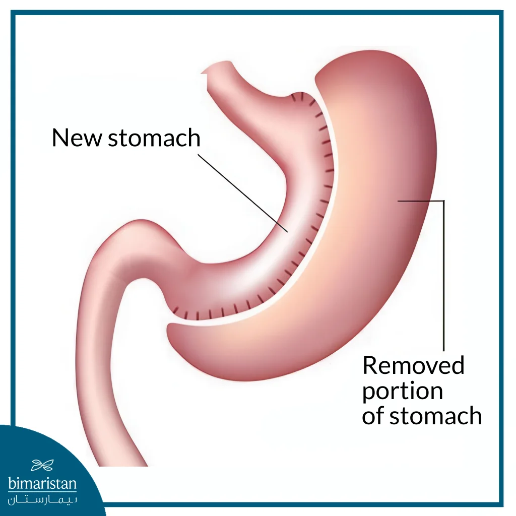 Gastric Sleeve Surgery Cost In Turkey: The Comprehensive Guide 2025 2 An Image Showing The Mechanism Of Gastric Sleeve Surgery And The Difference Between Stomach Size Before And After The Sleeve Surgery