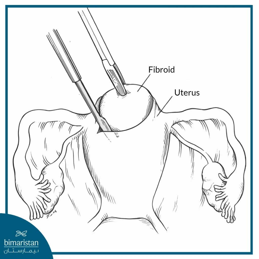 Laparoscopic Myomectomy Cost In Turkey: An Image Showing How The Tumor Is Removed