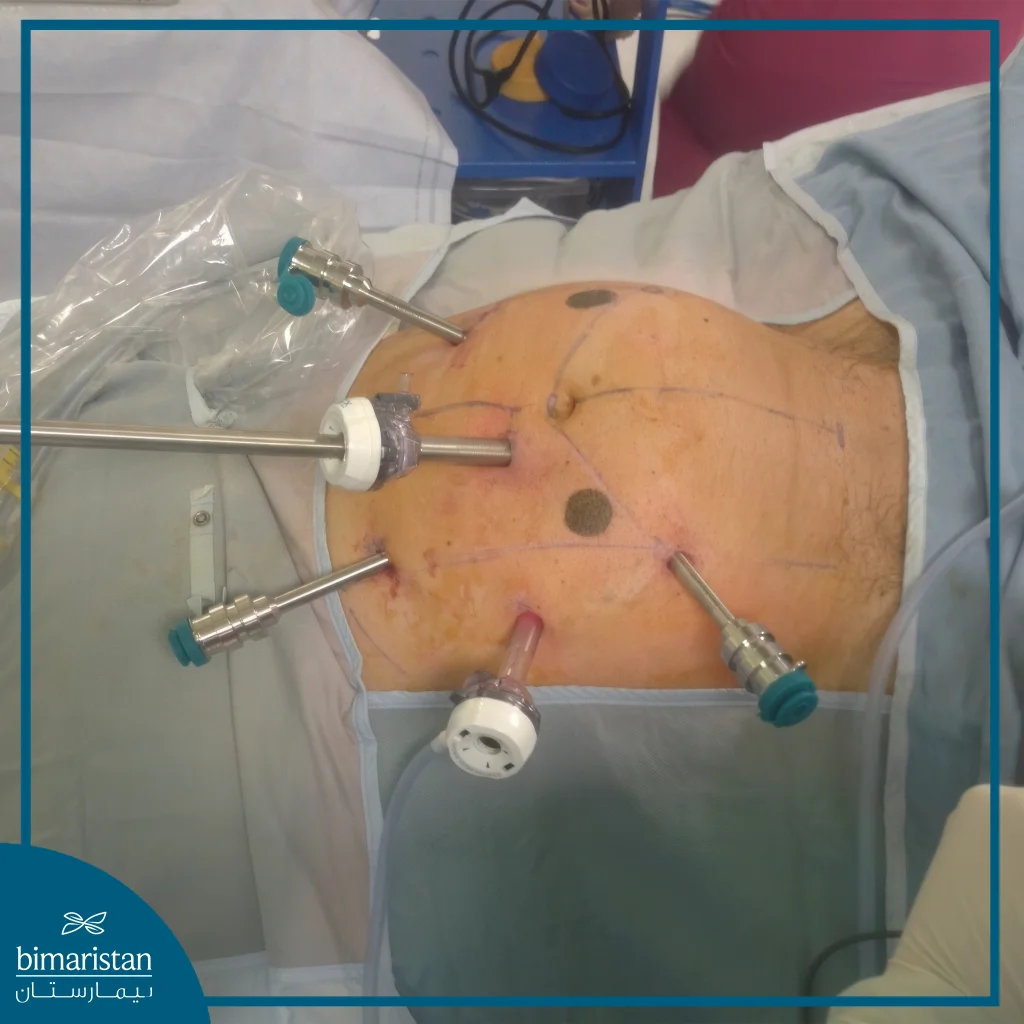 Image Showing The Removal Of A Colon Tumor With An Advanced Laparoscopic Technique, Commonly Used To Reduce Colon Tumor Resection Surgery Cost In Turkey.