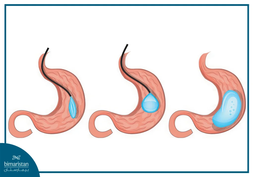 Gastric Balloon Cost In Turkey: An Image Illustrates How The Procedure Is Performed