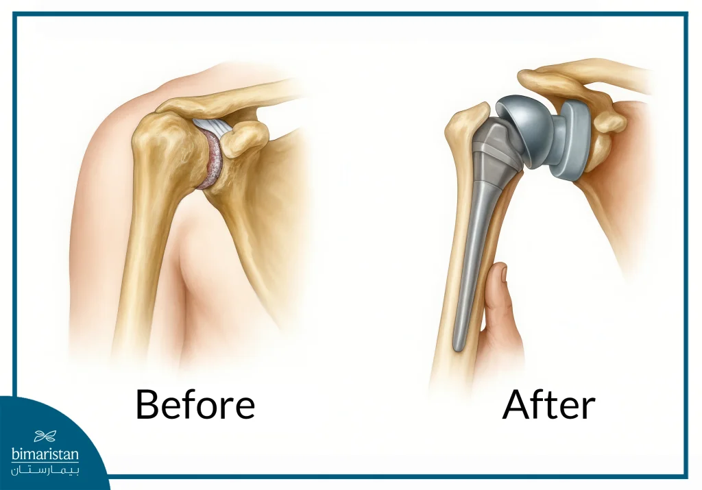 Shoulder Joint Replacement Cost In Turkey 2025: Affordable Solutions With Medical Excellence 1 Shoulder Joint Replacement Surgery: Before And After