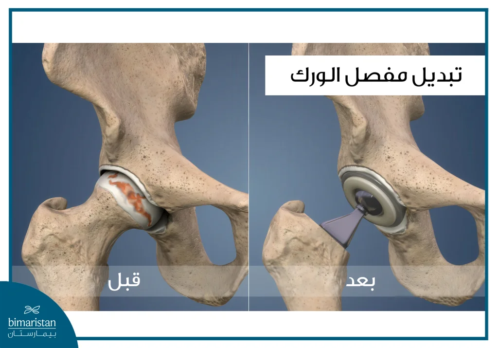 تكلفة تبديل مفصل الورك في تركيا 2025: تكلفة ستفاجئك! 2 تبديل مفصل الورك قبل وبعد