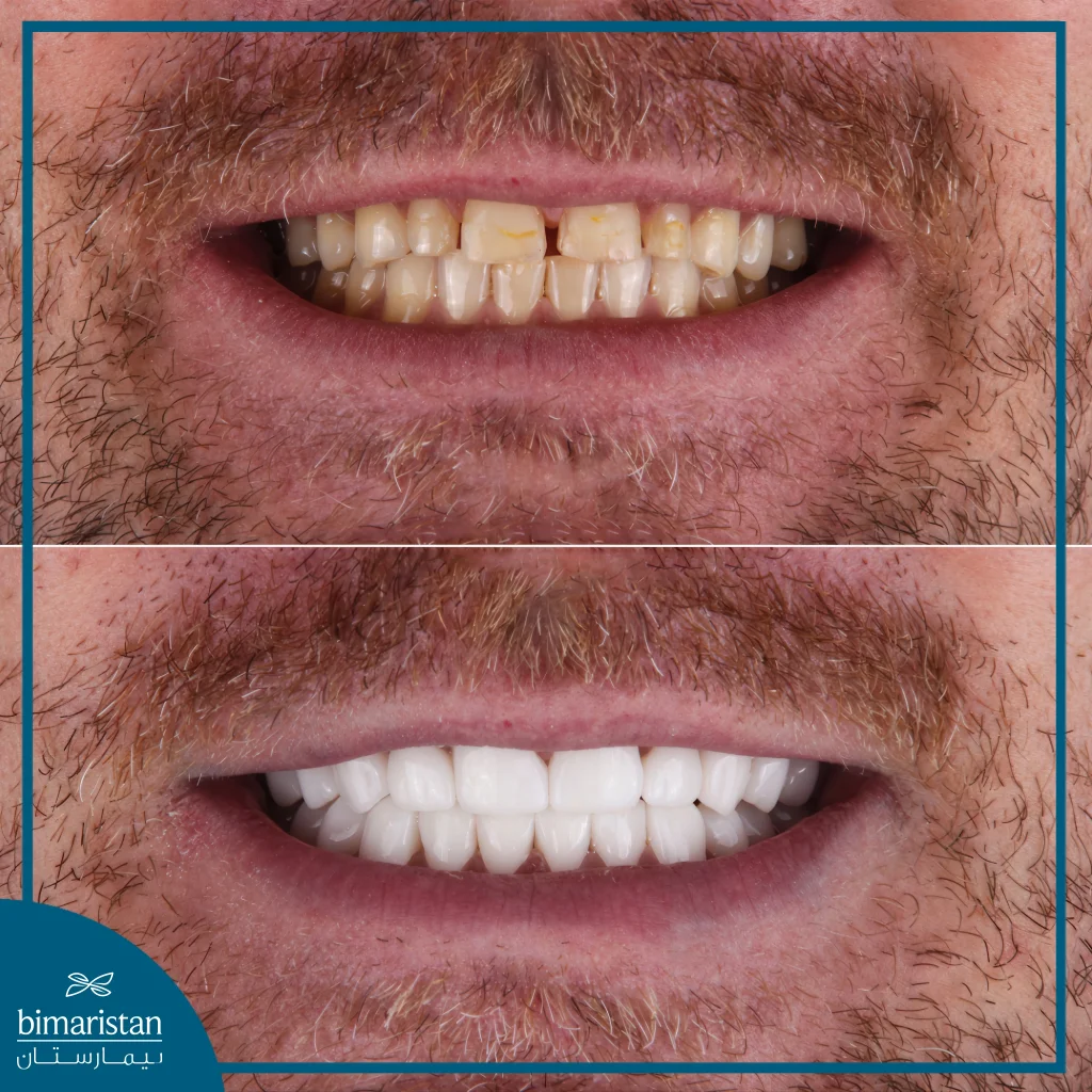 Zircon Crown Dressing: Before And After