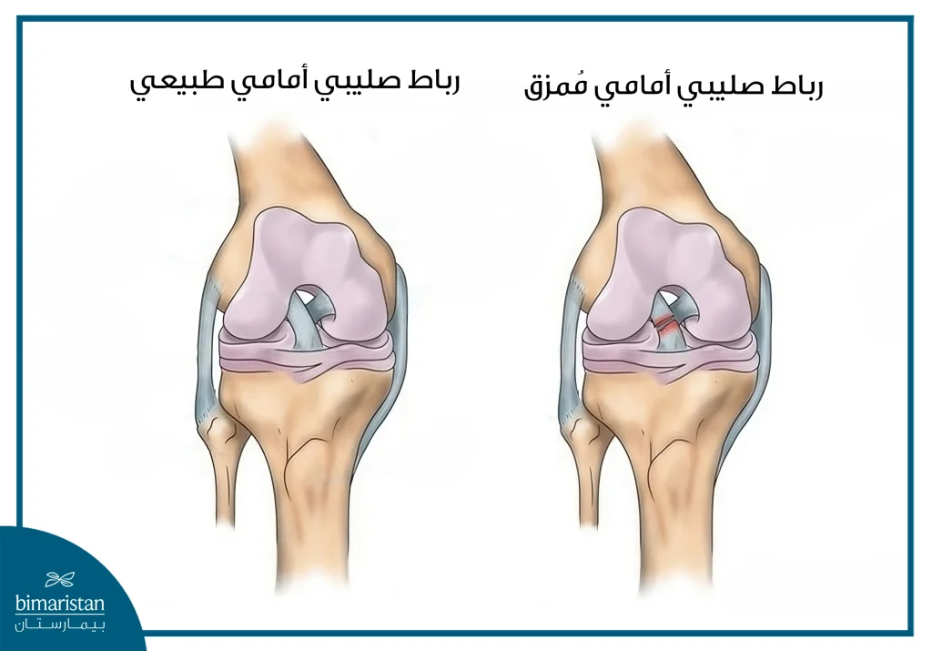 تكلفة تنظير الركبة: استثمار في صحة المفاصل 2 صورة توضح الفرق ما بين الرباط الصليبي الأمامي السليم والممزق