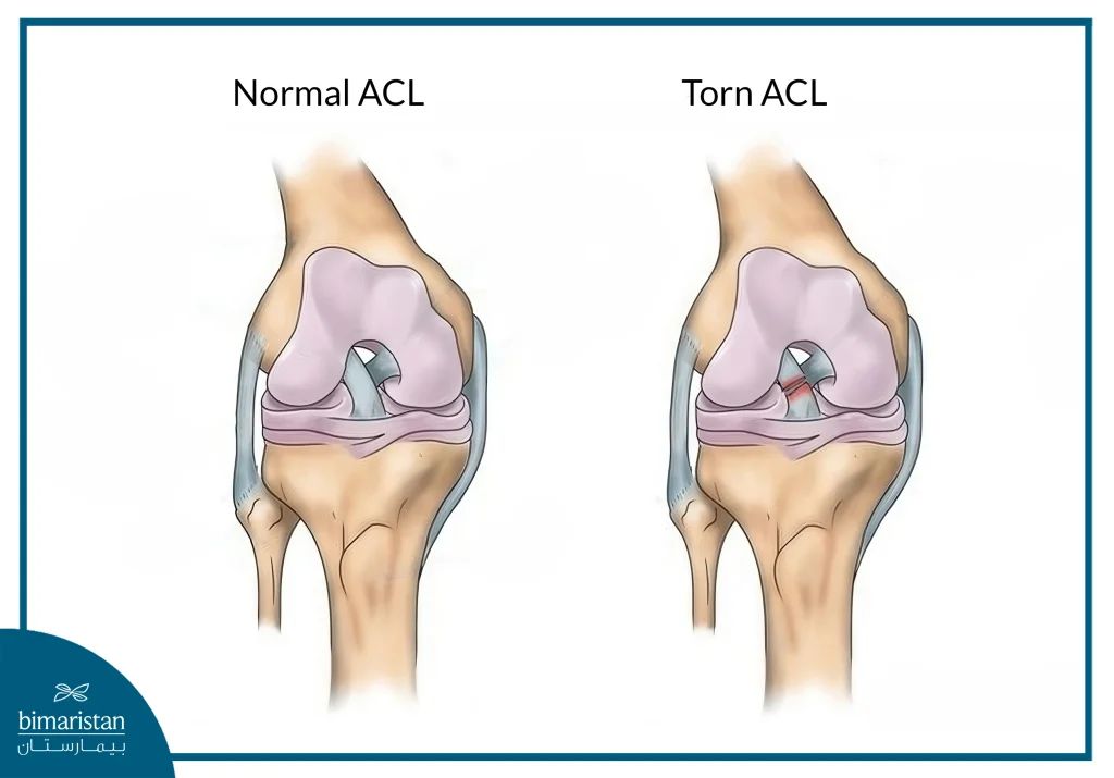 Image Illustrating The Difference Between A Healthy And A Torn Anterior Cruciate Ligament