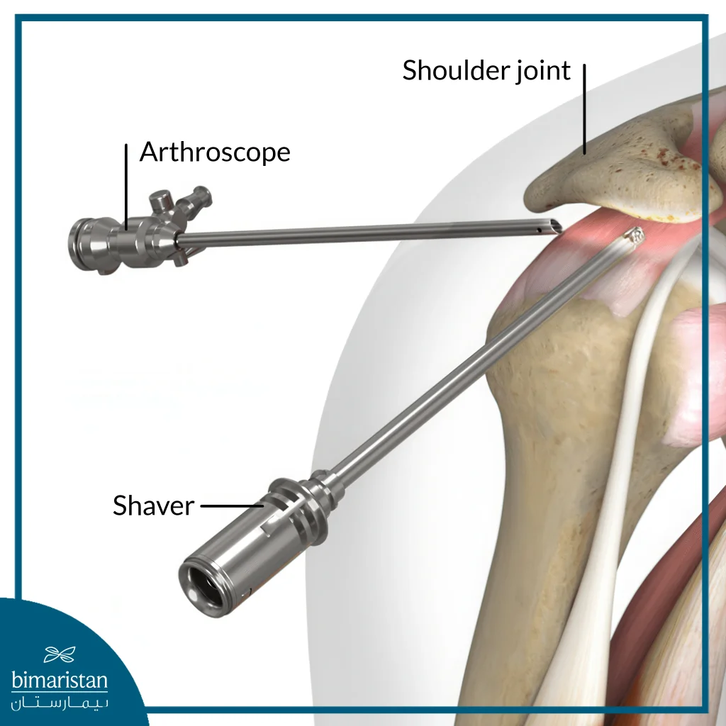 Shoulder Arthroscopy Cost In Turkey 2025: World-Class Quality With Unbelievable Prices 2 Shoulder Arthroscopy