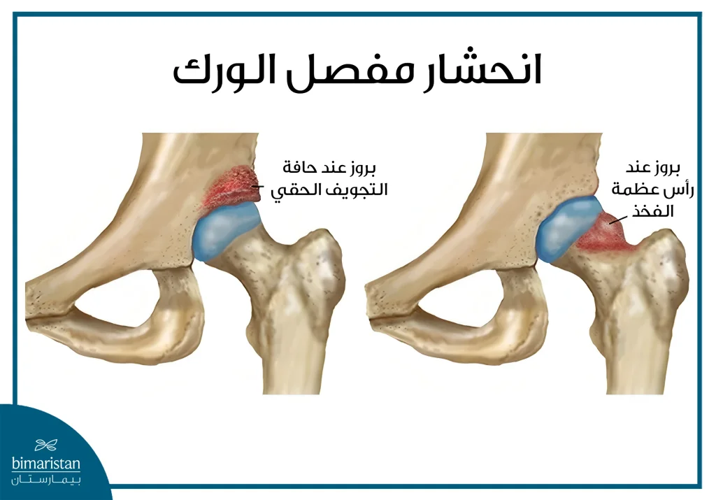 تكلفة تنظير الورك: حركة أفضل دون إنفاق ضخم 2 انحشار مفصل الورك بسبب تشكل عظم زائد على حافة الحق وعلى رأس عظم الفخذ