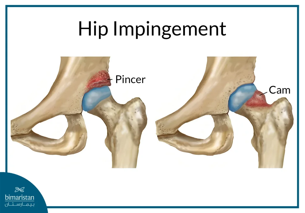 Hip Impingement Due To The Formation Of Excess Bone At The Rim Of The Acetabulum And On The Head Of The Femur