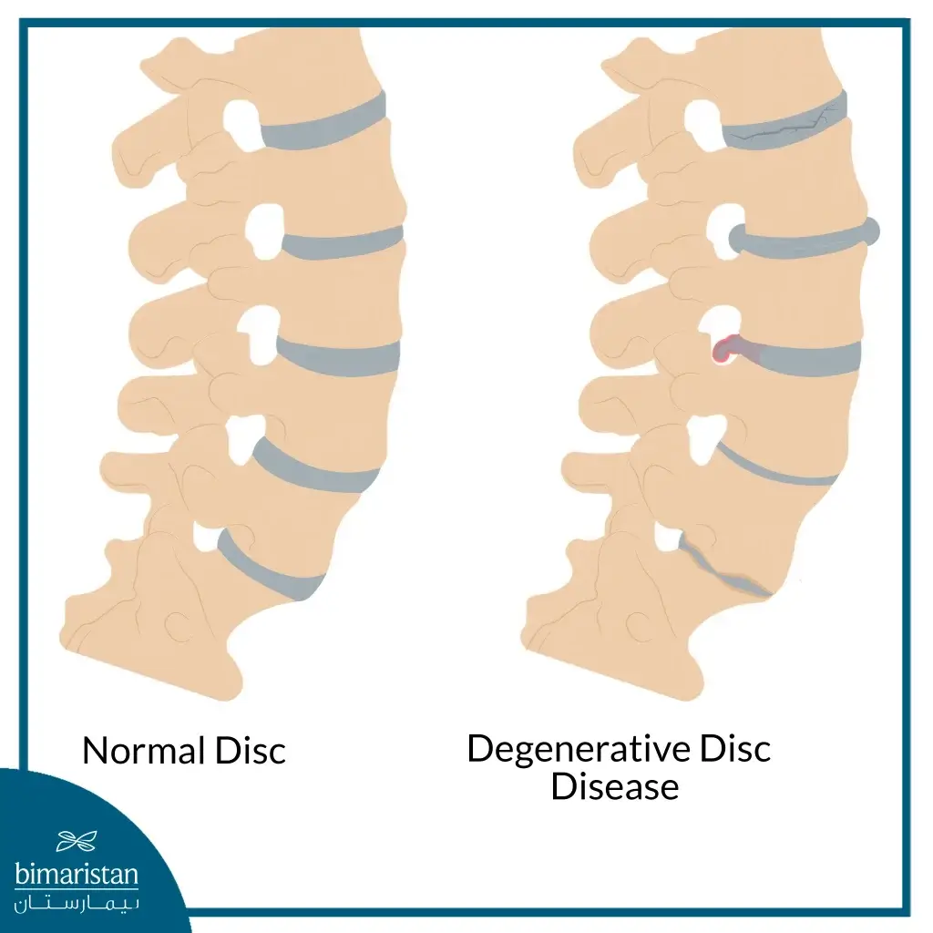 Degenerative Disc Disease Surgery Cost In Turkey Guide 2 Comparison Of A Normal Spine And Spinal Degeneration Helps Explain The Need For Treatment And Highlights Factors Influencing Degenerative Disc Disease Surgery Cost.