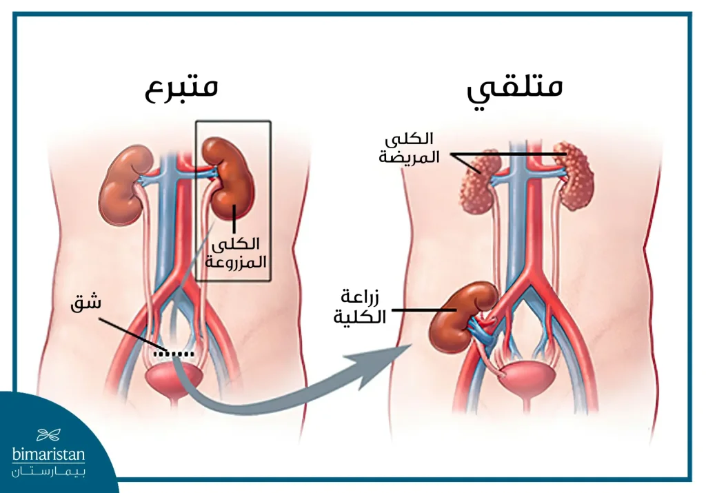 تكلفة زراعة الكلى في تركيا: دليل شامل لعام 2025 2 طريقة زراعة الكلى