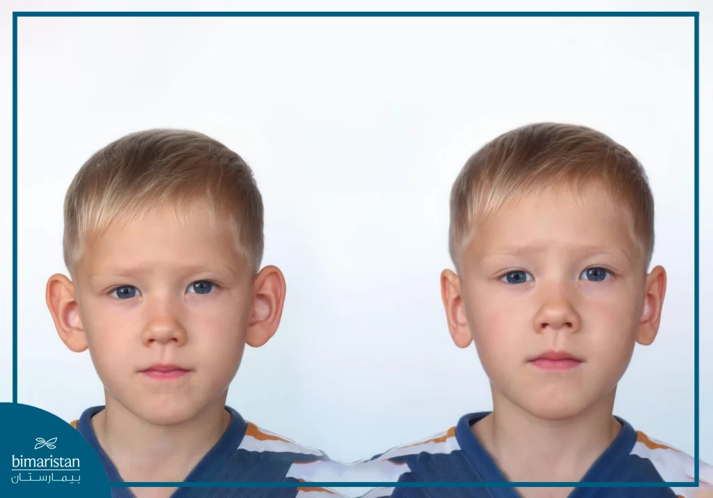 Prominent Ear Treatment Cost In Turkey: Your Comprehensive 2025 Guide 2 Amazing Otoplasty Results: The Visible Difference Between Before And After Surgical Correction With High Precision Reflects The Value Of Prominent Ear Treatment Cost In Turkey.